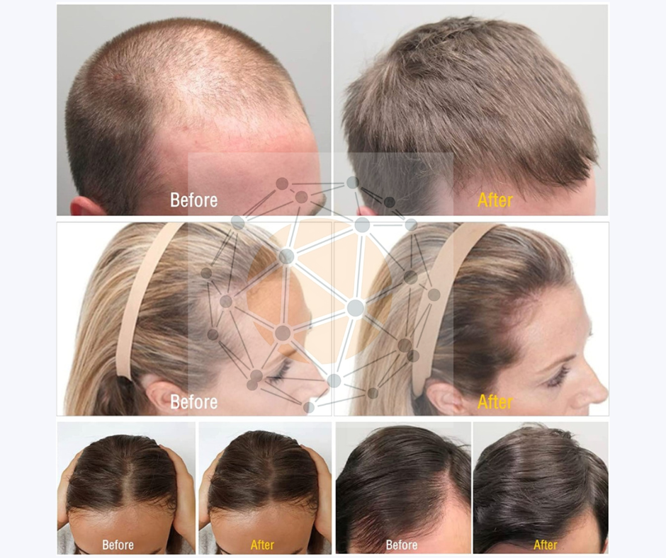 minoxidil-finastarida-acido-hialuronico-somed-otesaly-botox-caida-de-cabello-pelo-ecuador-1-940x788