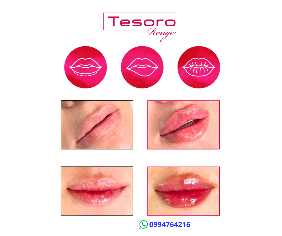 tesoro rojo rouge acido hialuronico para labios 5